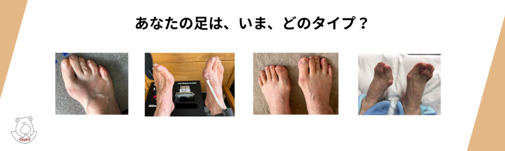あなたの足は、どのタイプ？